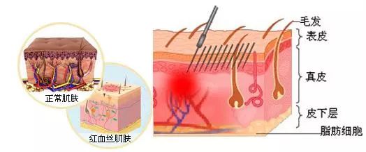 紅血絲是什么原因?qū)е碌?/></span></p><p style=