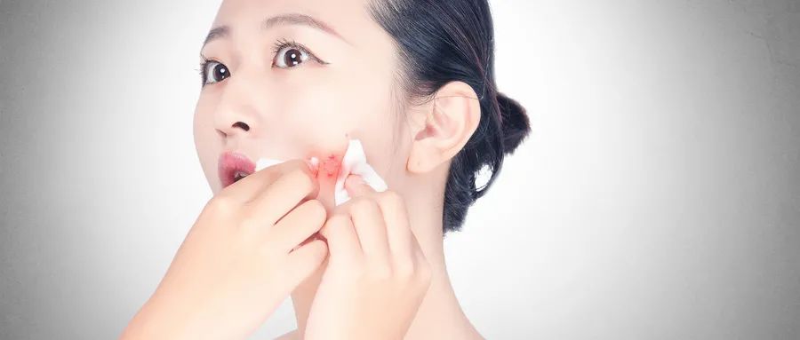 如何預防粉刺的發(fā)生和痤瘡的形成？
