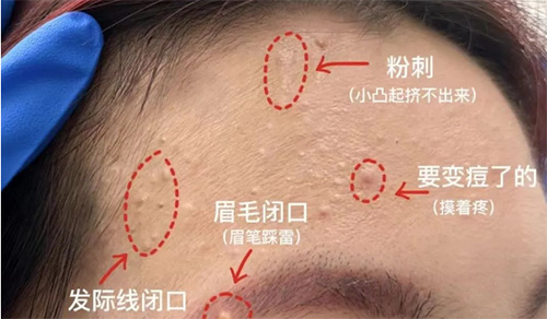 臉上經(jīng)常長閉口粉刺的原因有哪些？