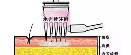 水光針的類型有哪幾種？