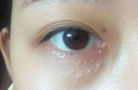 為什么眼部容易長(zhǎng)脂肪粒？