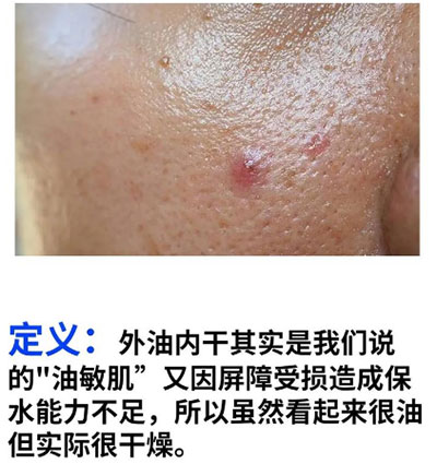 油痘肌和油敏肌怎么區(qū)分？油痘肌和油敏肌的區(qū)別！
