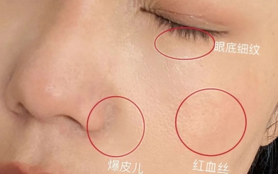 如何判斷自己是不是干敏肌膚？干敏肌有哪些特征？
