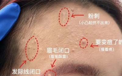 臉上經(jīng)常長閉口粉刺的原因有哪些？