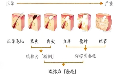 黑頭怎么去除最有效？去除黑頭最有效的方法