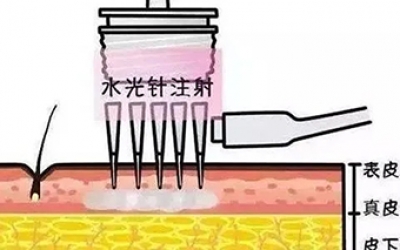 水光針的類型有哪幾種？