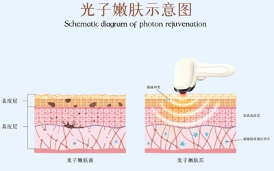 光子嫩膚術前注意事項有哪些？