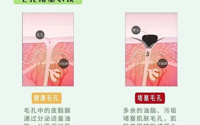 毛孔堵塞怎么疏通毛孔？