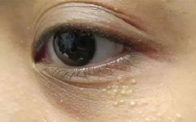 脂肪粒怎么樣才能去除？脂肪粒的去除方法！